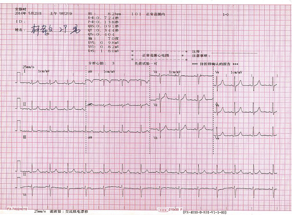 EKG