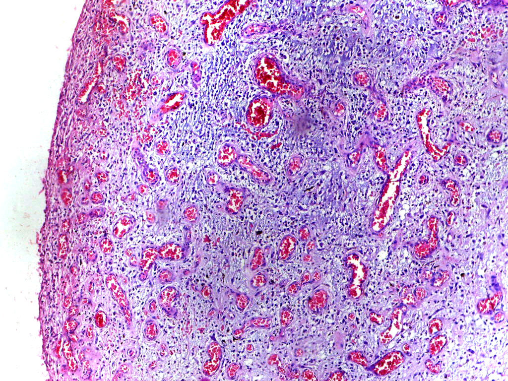 inflammation