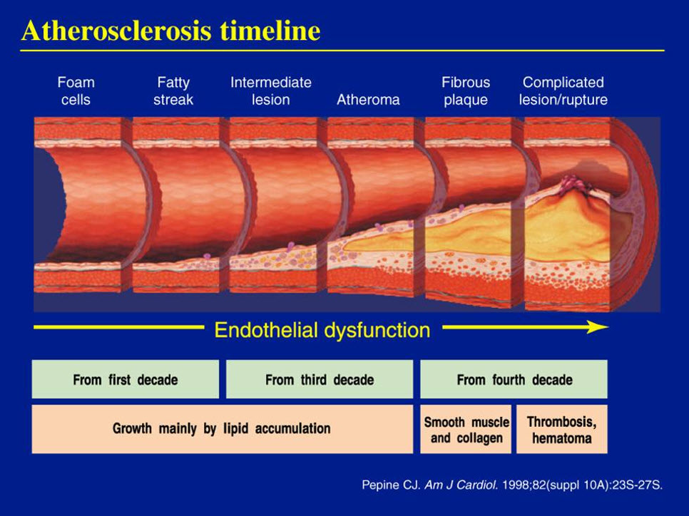 atherosclerosis timeline chart