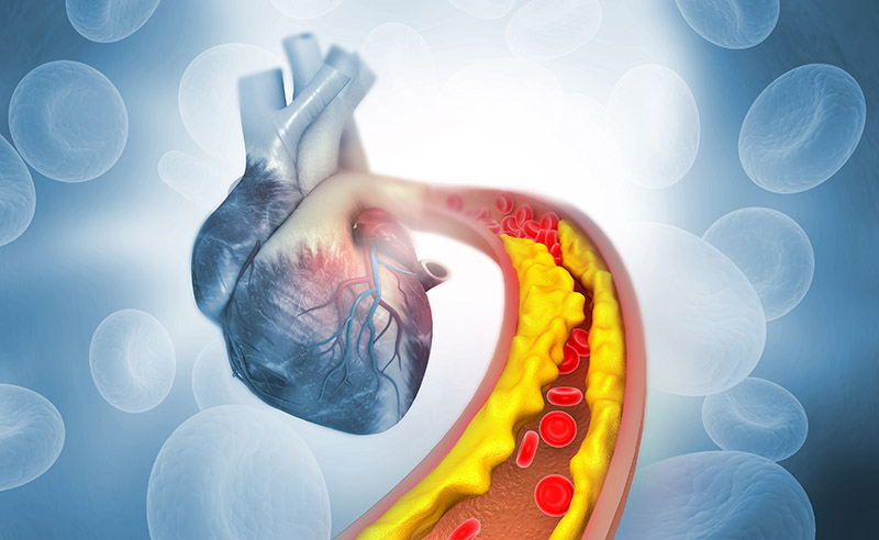 cholesterol in arteries